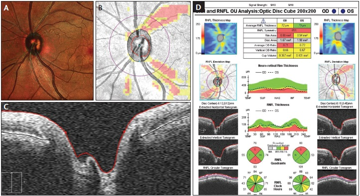 Glaucoma RNFL Analysis