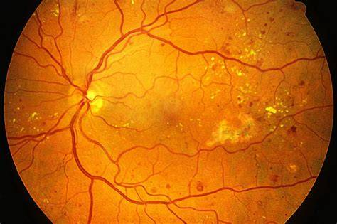 Diabetic Retinopathy Fundus